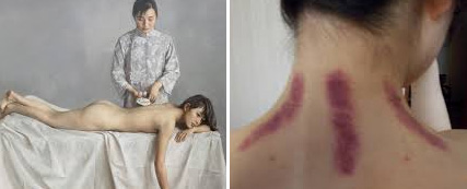 Gua sha Gua sha