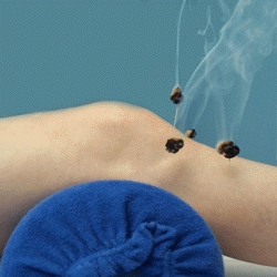 Moxibustion