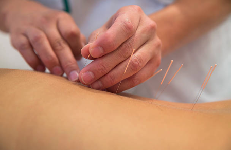 Une séance d'acupuncture Une séance d'acupuncture